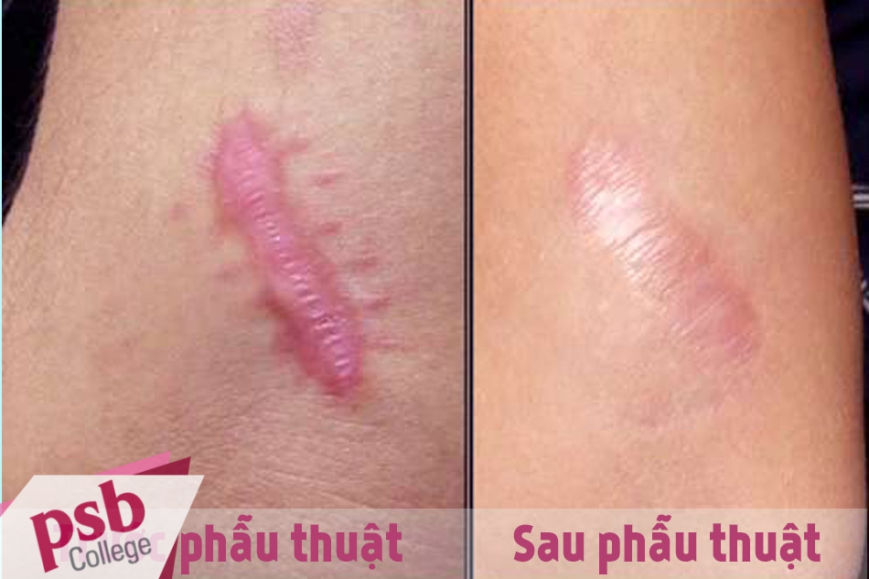 Trước và sau khi phẫu thuật cắt bỏ sẹo