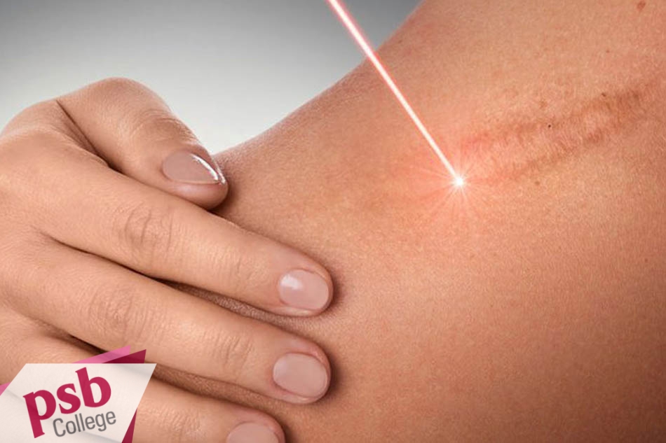 Điều trị sẹo bằng tia laze