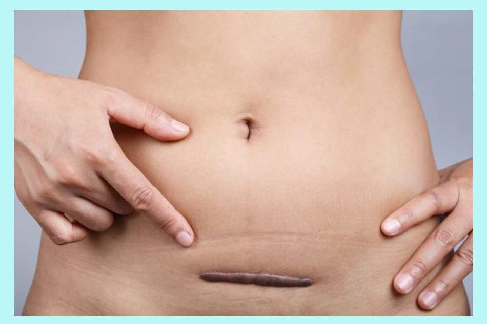 Tại sao phải kiêng quan hệ sau sinh mổ