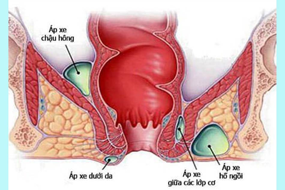 Thịt thừa ở hậu môn do áp xe hậu môn