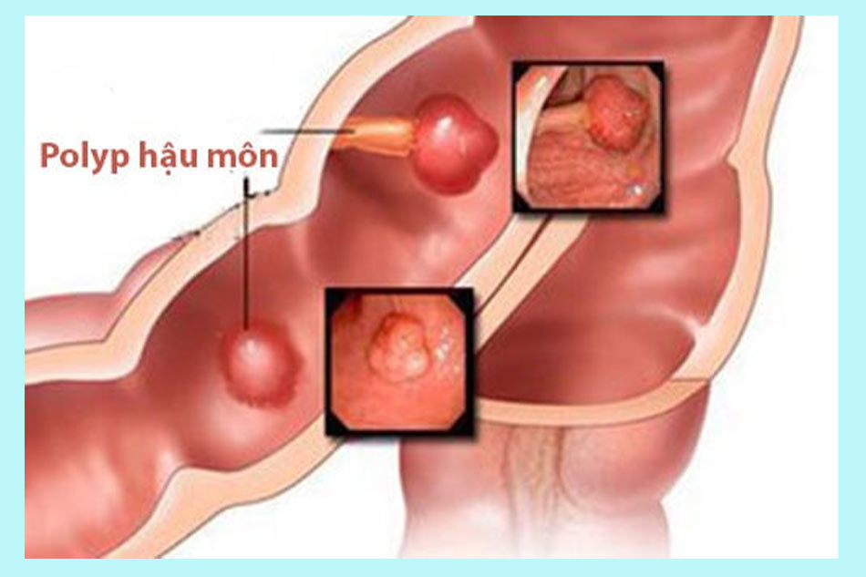 Thịt thừa ở hậu môn do Polyp hậu môn