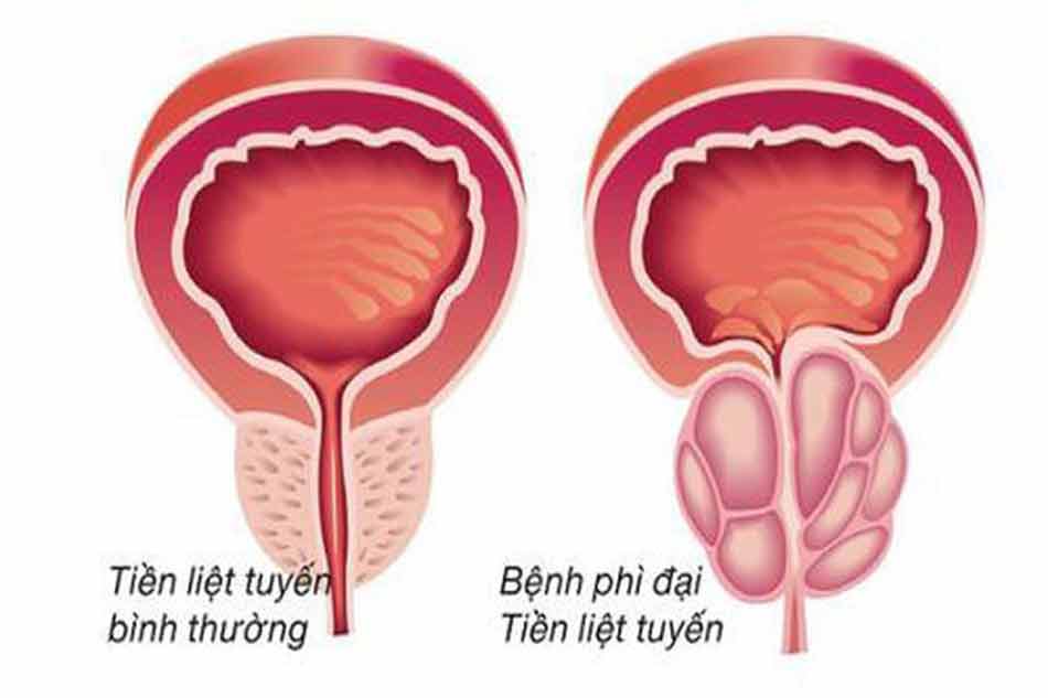 Cả Tiền Liệt Vương và Vương Bảo đều hỗ trợ điều trị các bệnh về tuyến tiền liệt