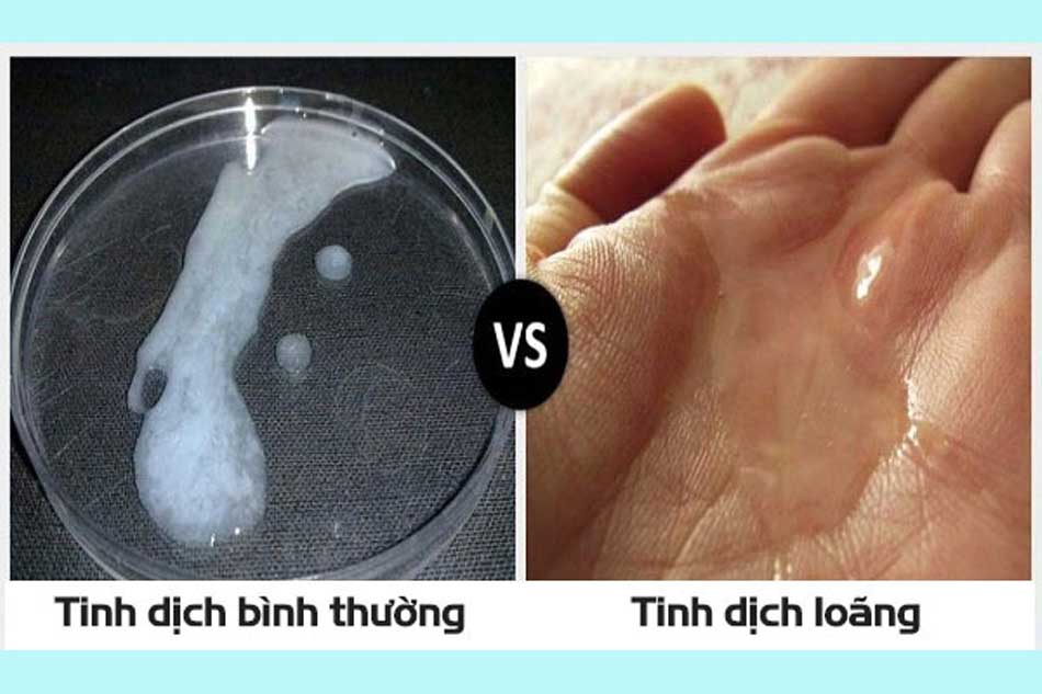 Dấu hiệu nhận biết tinh trùng yếu