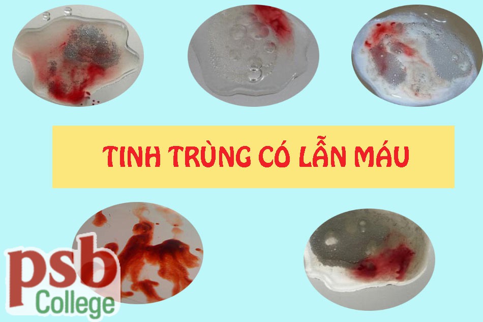 Hình ảnh tinh trùng có lẫn máu
