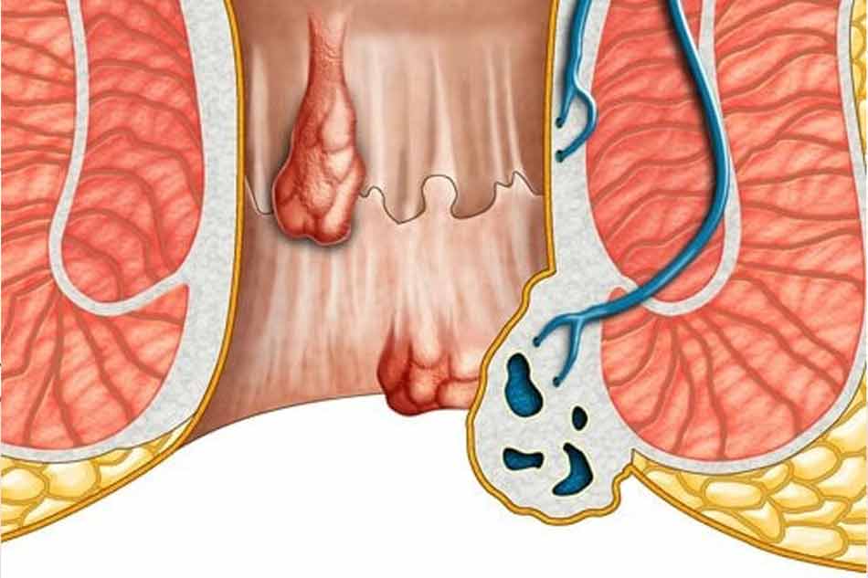 Có lưu ý gì khi dùng tỏi chữa trĩ